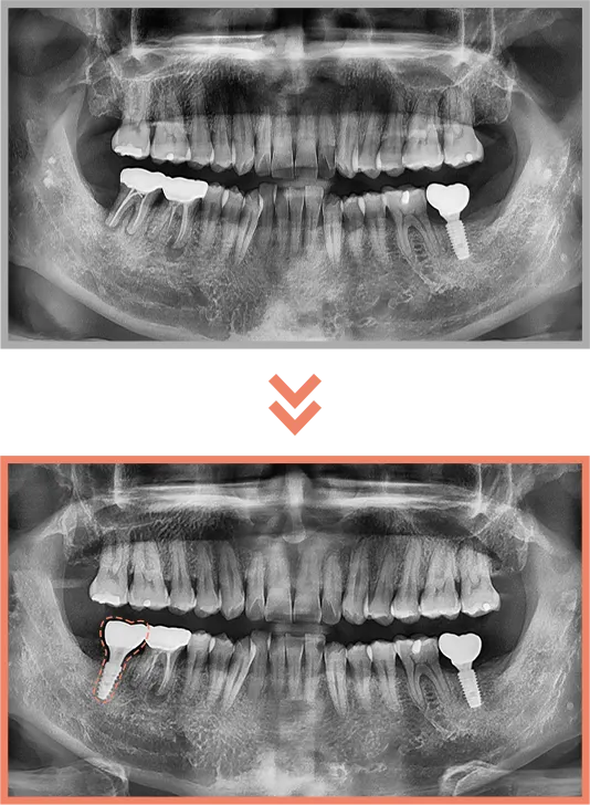 임플란트 증례07