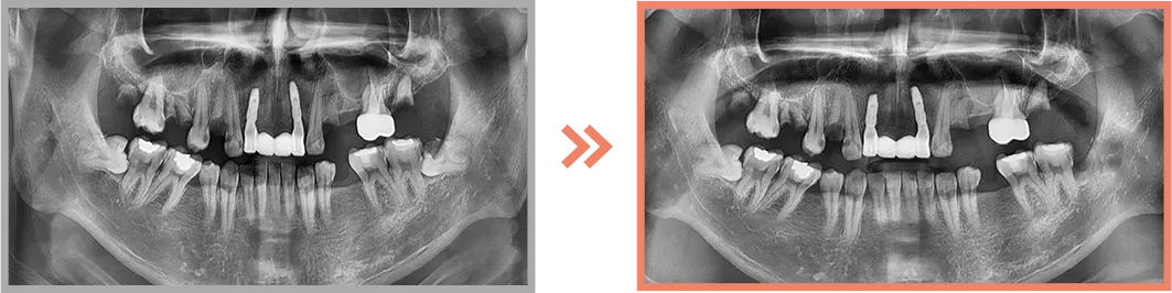 사랑니 발치 증례04