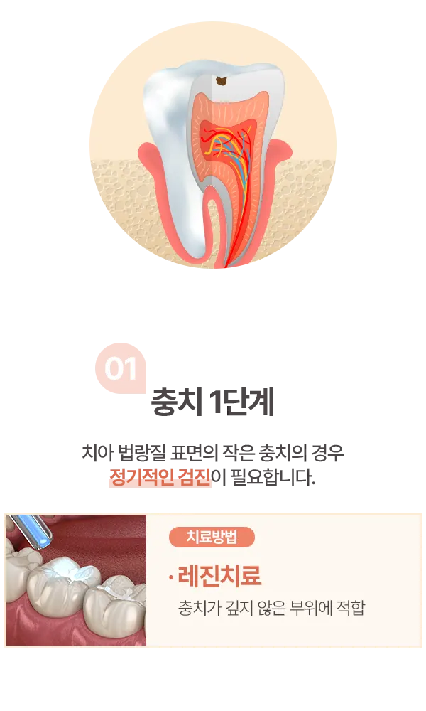 충치 1단계