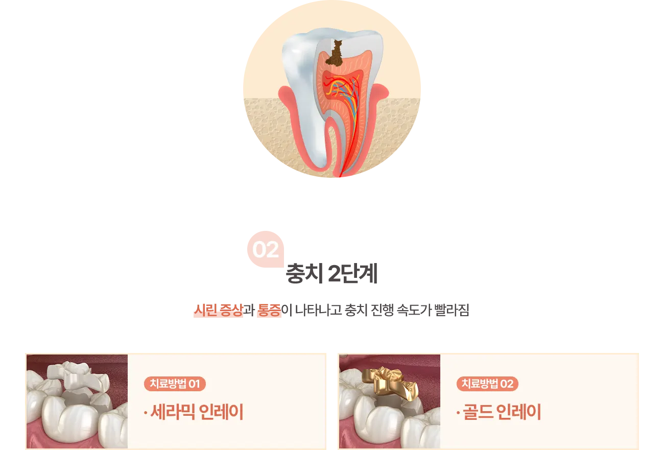충치 2단계