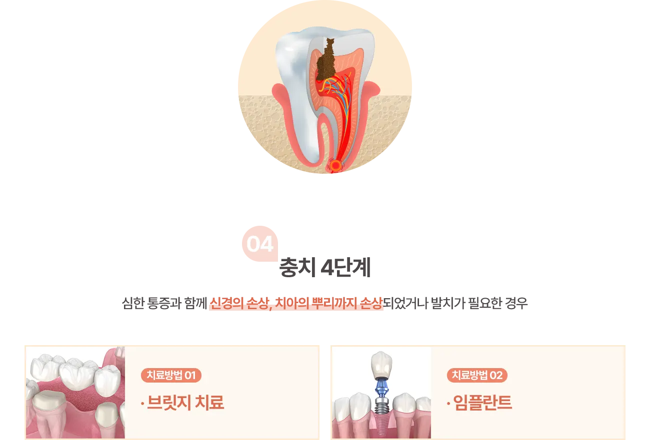 충치 4단계