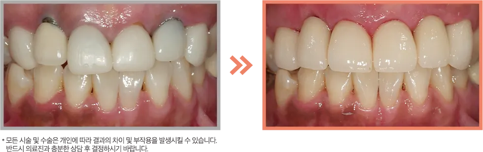 앞니 지르코니아 증례