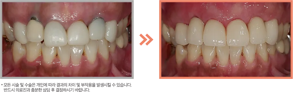 잇몸이식 증례